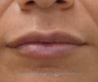 Lip Filler Before & After Gallery - Patient 407173 - Image 2