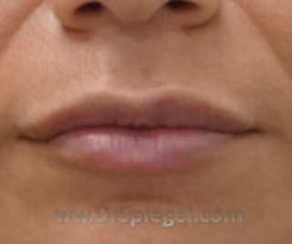 Lip Filler Before & After Gallery - Patient 407173 - Image 2