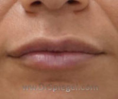 Lip Filler Before & After Gallery - Patient 407173 - Image 2
