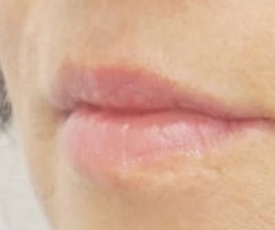 Lip Filler Before & After Gallery - Patient 407173 - Image 3