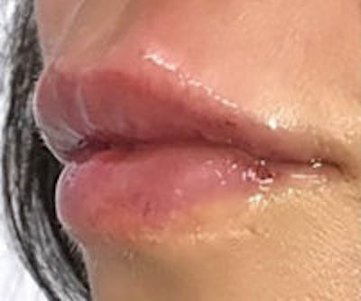 Lip Filler Before & After Gallery - Patient 407173 - Image 4