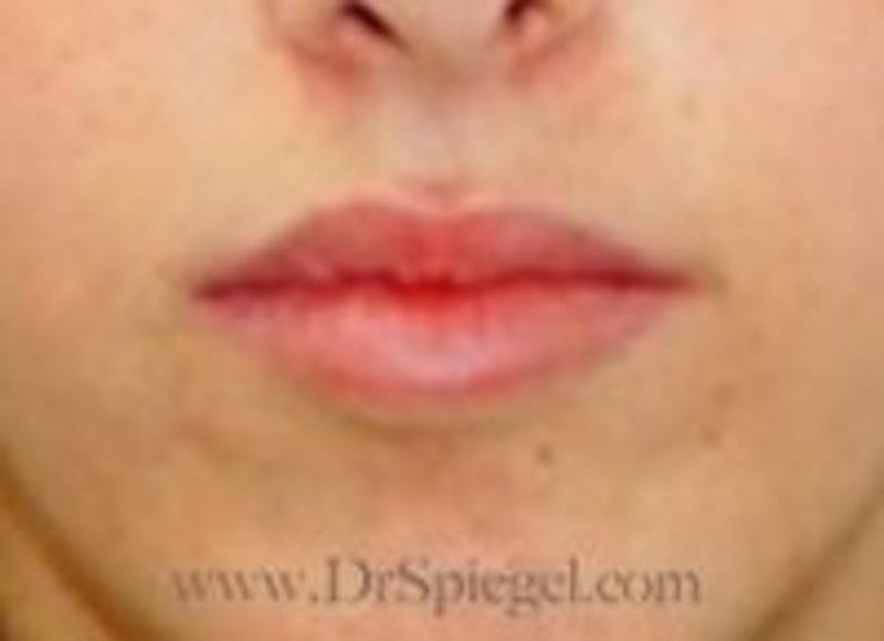 Lip Filler Before & After Gallery - Patient 208945 - Image 1