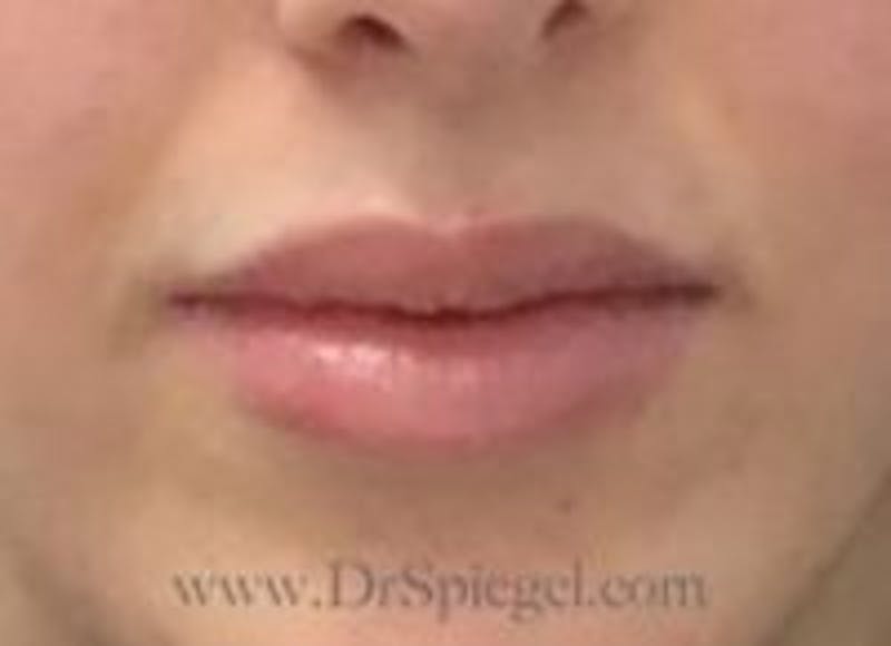Lip Filler Before & After Gallery - Patient 208945 - Image 2