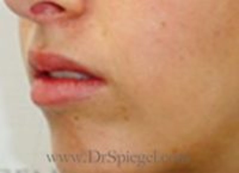 Lip Filler Before & After Gallery - Patient 208945 - Image 3