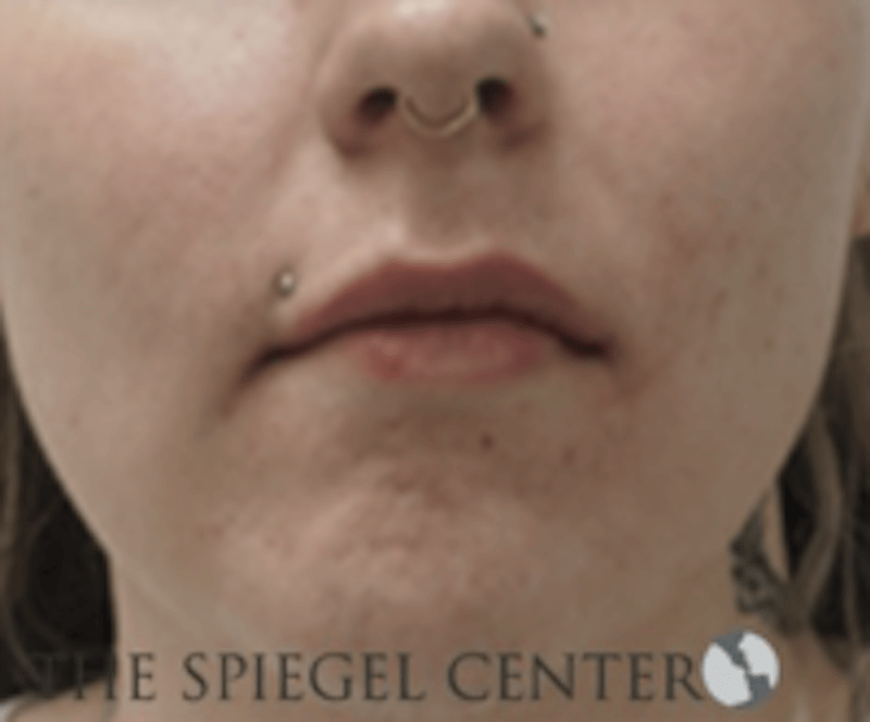 Lip Filler Before & After Gallery - Patient 407560 - Image 1