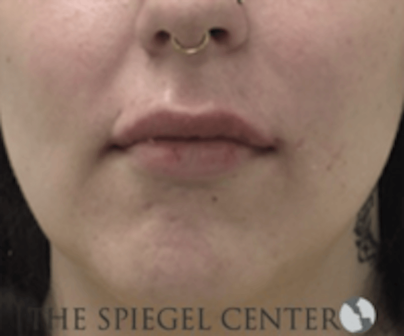 Lip Filler Before & After Gallery - Patient 407560 - Image 2