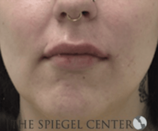 Lip Filler Before & After Gallery - Patient 407560 - Image 2