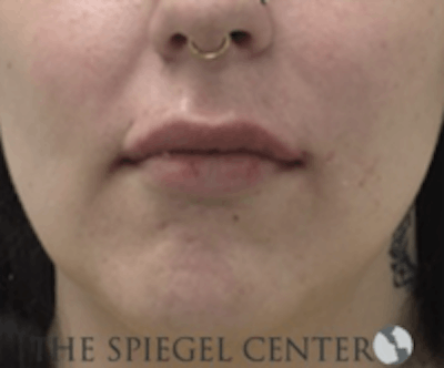 Lip Filler Before & After Gallery - Patient 407560 - Image 2
