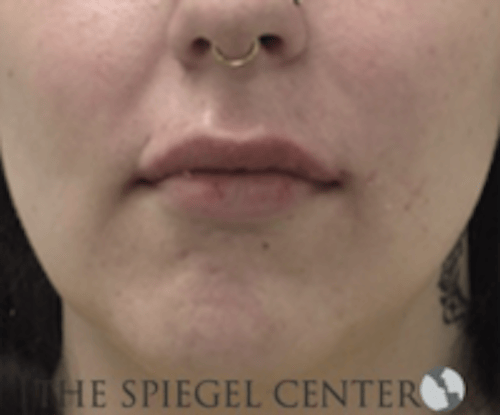 Lip Filler Before & After Gallery - Patient 407560 - Image 2