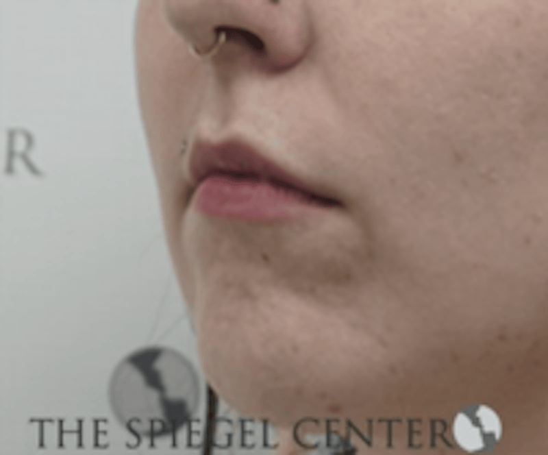 Lip Filler Before & After Gallery - Patient 407560 - Image 3