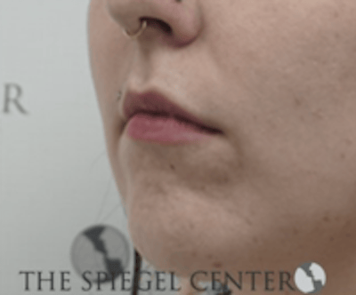 Lip Filler Before & After Gallery - Patient 407560 - Image 3
