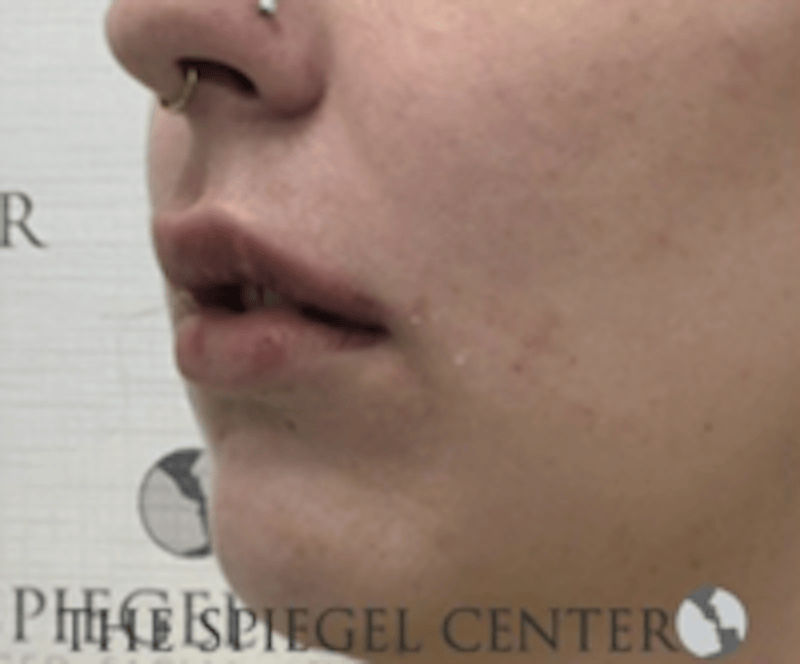 Lip Filler Before & After Gallery - Patient 407560 - Image 4