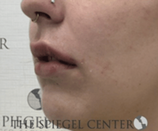 Lip Filler Before & After Gallery - Patient 407560 - Image 4