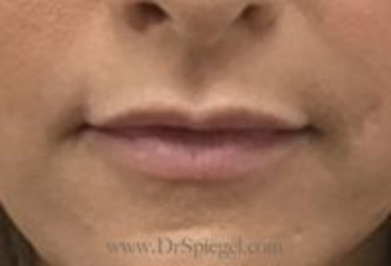 Lip Filler Before & After Gallery - Patient 234555 - Image 1