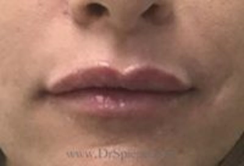 Lip Filler Before & After Gallery - Patient 234555 - Image 2