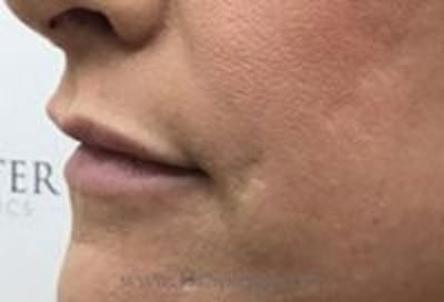 Lip Filler Before & After Gallery - Patient 234555 - Image 3