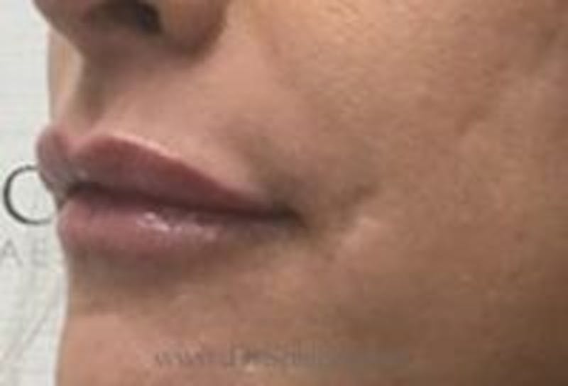 Lip Filler Before & After Gallery - Patient 234555 - Image 4