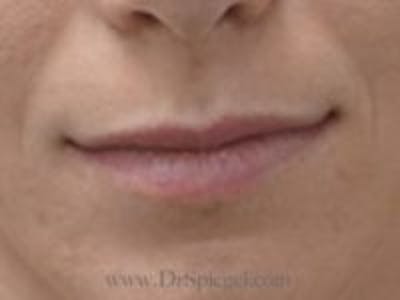 Lip Filler Before & After Gallery - Patient 179716 - Image 1
