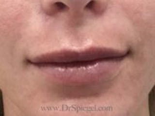 Lip Filler Before & After Gallery - Patient 179716 - Image 2