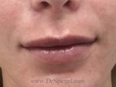 Lip Filler Before & After Gallery - Patient 179716 - Image 2