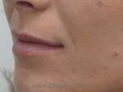 Lip Filler Before & After Gallery - Patient 179716 - Image 3
