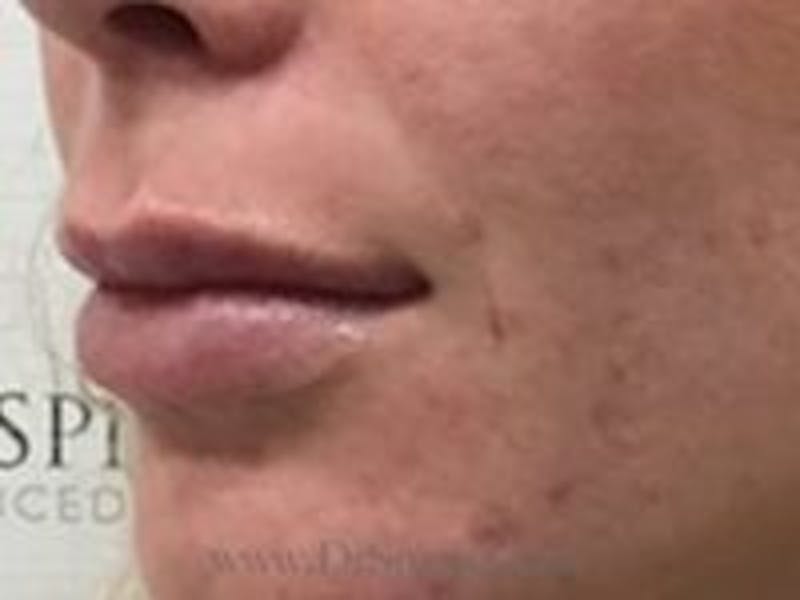 Lip Filler Before & After Gallery - Patient 179716 - Image 4