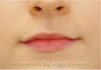 Lip Filler Before & After Gallery - Patient 123090 - Image 1