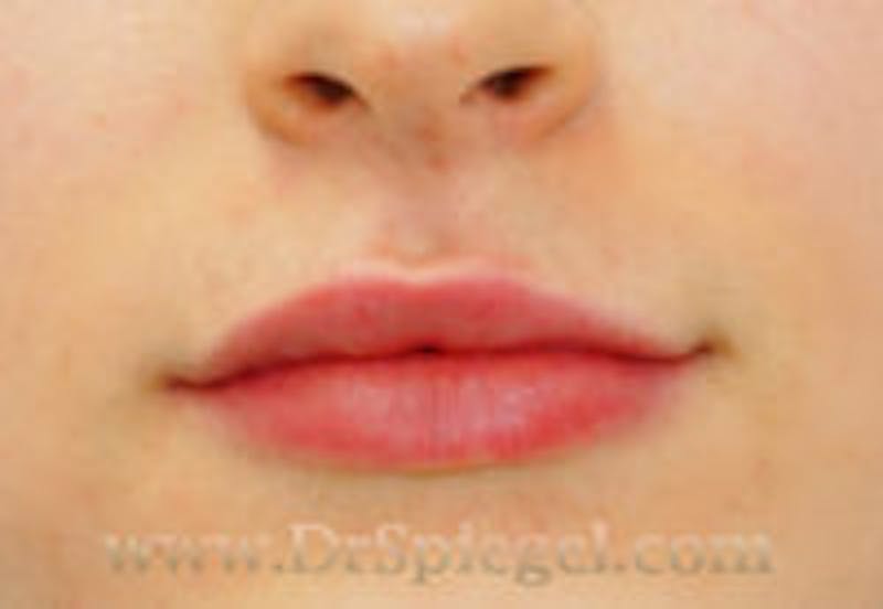 Lip Filler Before & After Gallery - Patient 123090 - Image 2