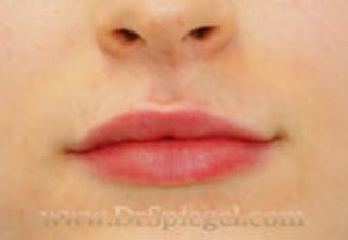Lip Filler Before & After Gallery - Patient 123090 - Image 2