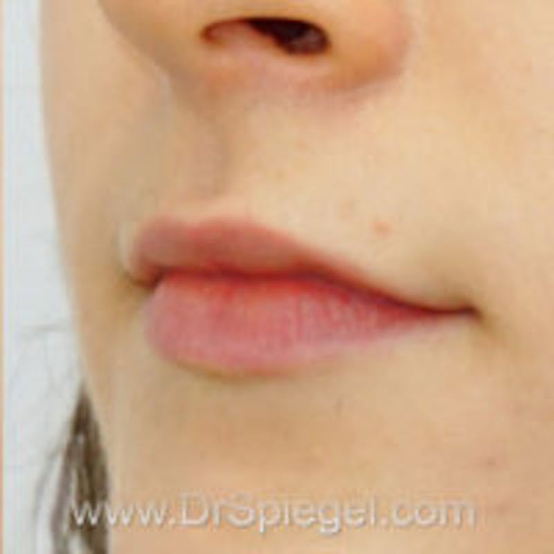 Lip Filler Before & After Gallery - Patient 123090 - Image 3