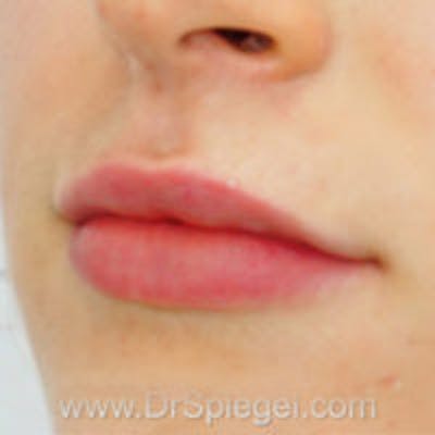 Lip Filler Before & After Gallery - Patient 123090 - Image 4