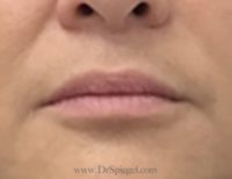 Lip Filler Before & After Gallery - Patient 262778 - Image 1