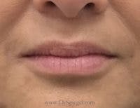 Lip Filler Before & After Gallery - Patient 262778 - Image 2