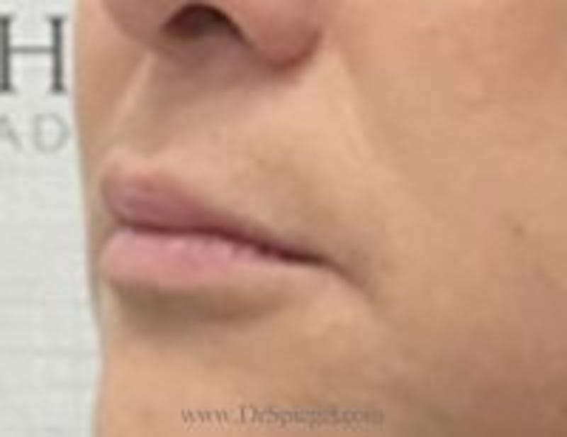 Lip Filler Before & After Gallery - Patient 262778 - Image 3