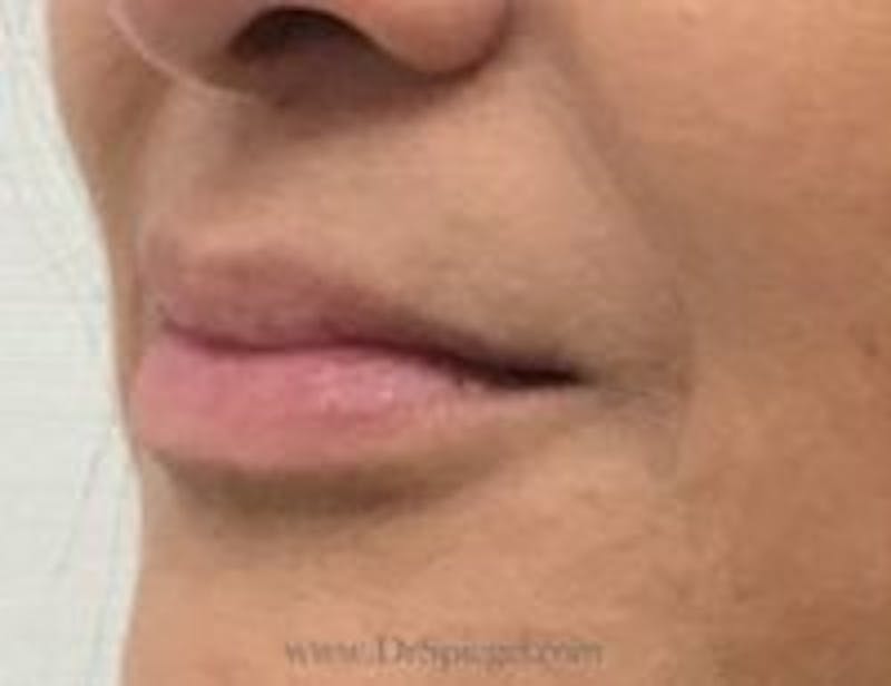 Lip Filler Before & After Gallery - Patient 262778 - Image 4