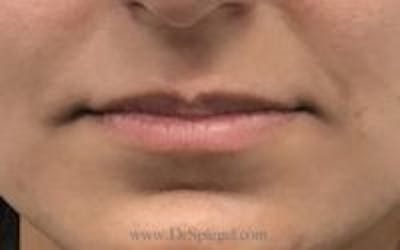Lip Filler Before & After Gallery - Patient 130060 - Image 1