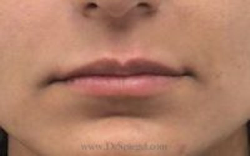 Lip Filler Before & After Gallery - Patient 130060 - Image 2