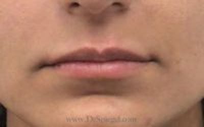 Lip Filler Before & After Gallery - Patient 130060 - Image 2