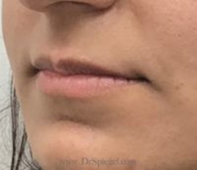 Lip Filler Before & After Gallery - Patient 130060 - Image 3