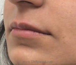 Lip Filler Before & After Gallery - Patient 130060 - Image 4