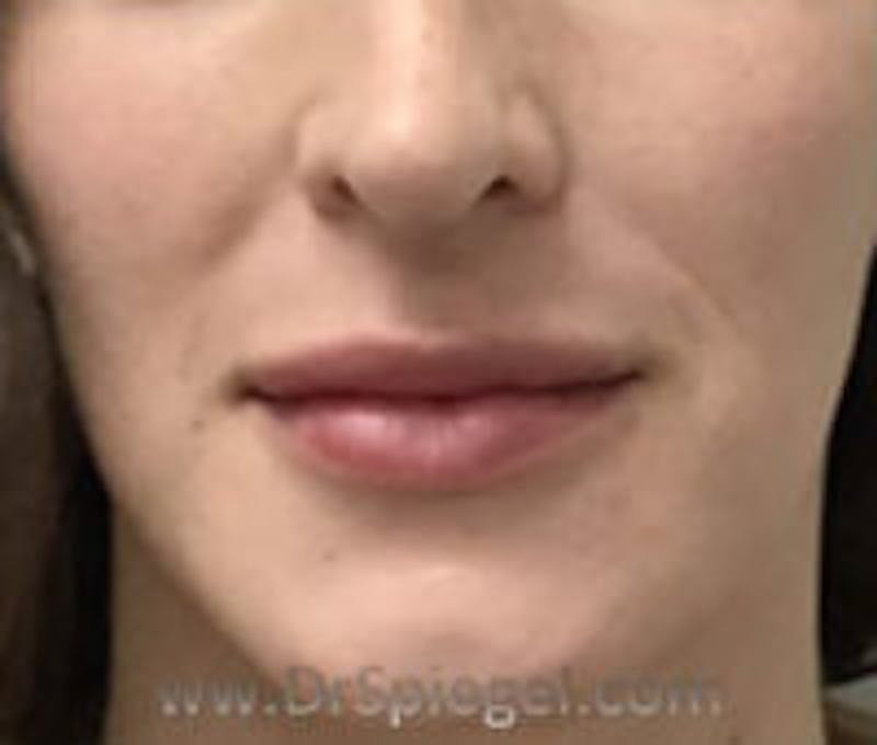 Lip Filler Before & After Gallery - Patient 258292 - Image 2