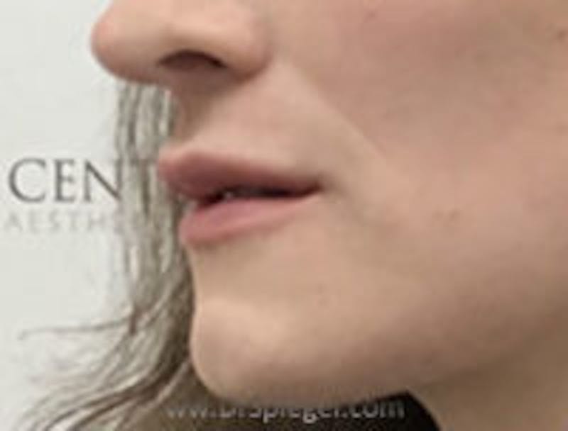 Lip Filler Before & After Gallery - Patient 258292 - Image 3
