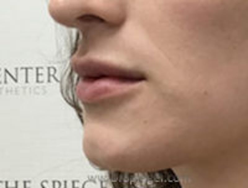 Lip Filler Before & After Gallery - Patient 258292 - Image 4
