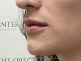 Lip Filler Before & After Gallery - Patient 258292 - Image 4