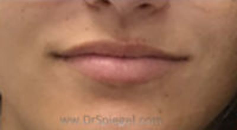 Lip Filler Before & After Gallery - Patient 380890 - Image 1