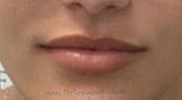 Lip Filler Before & After Gallery - Patient 380890 - Image 2