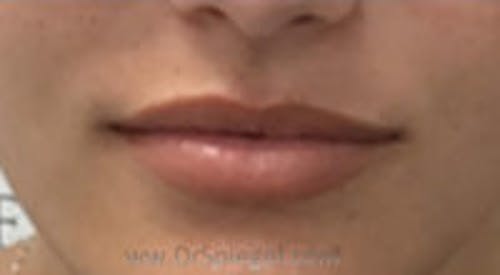 Lip Filler Before & After Gallery - Patient 380890 - Image 2