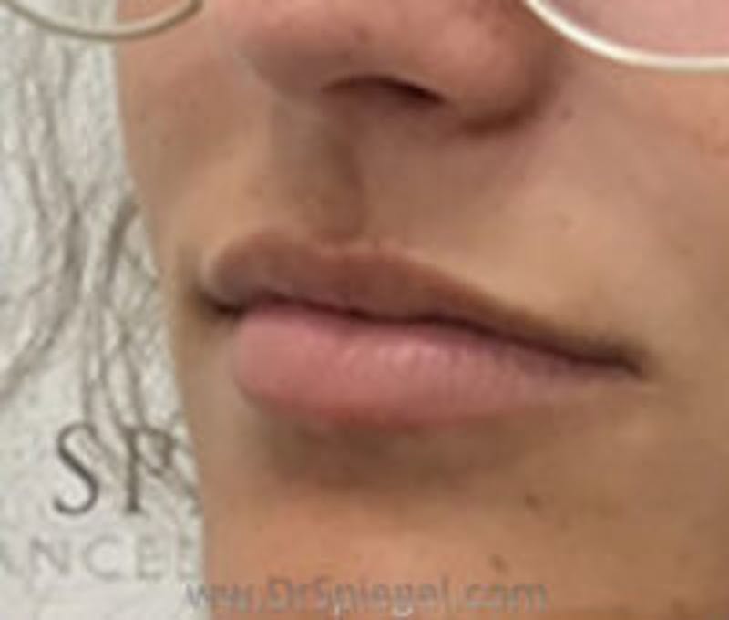 Lip Filler Before & After Gallery - Patient 380890 - Image 3