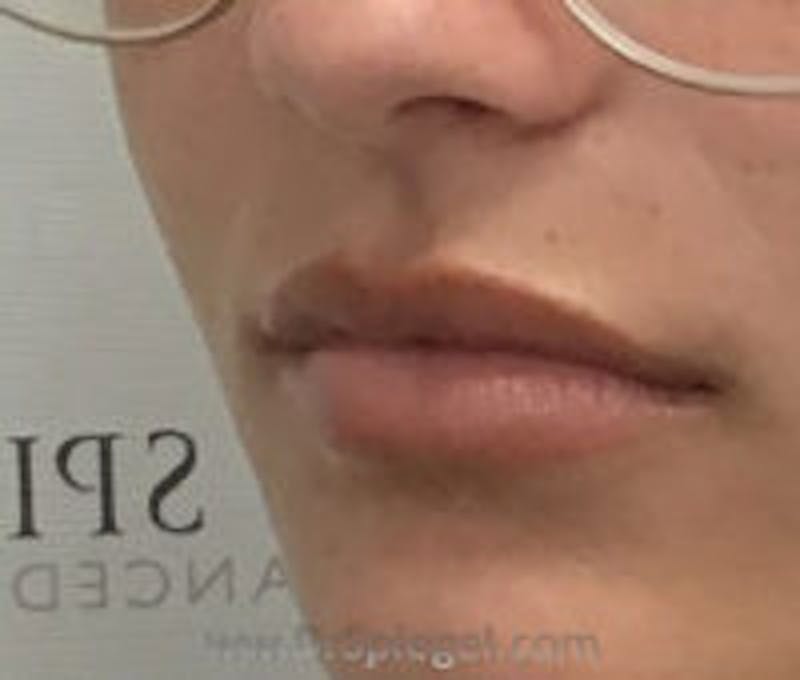 Lip Filler Before & After Gallery - Patient 380890 - Image 4