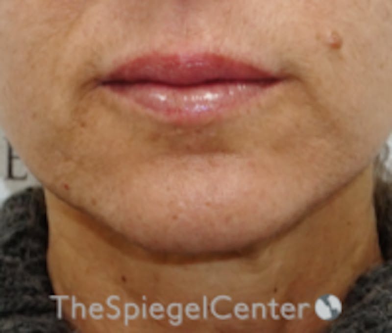 Lip Filler Before & After Gallery - Patient 262042 - Image 1